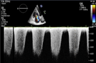 Pulmonary hypertension eLearning module